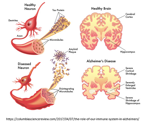 Alzheimer's Disease Pathology